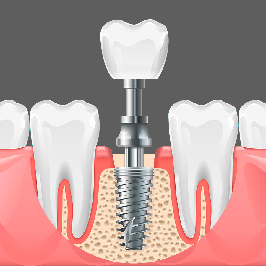 Implantate in Zusammenarbeit mit der Zahnarztpraxis Hangert in Stuhr