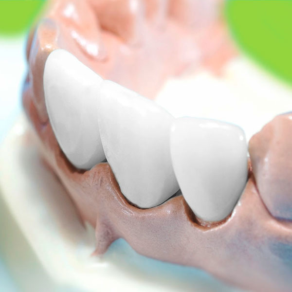 Kronen, Brücken und Zahnersatz in der Zahnarztpraxis Mara Tipter in Hude