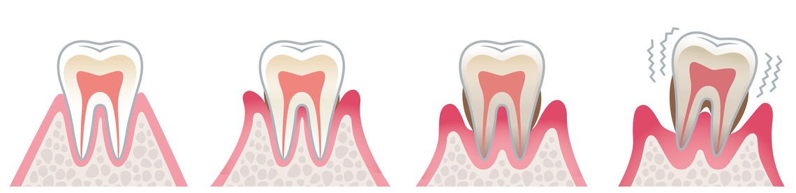 Zahnarzt Tipter Parodontologie